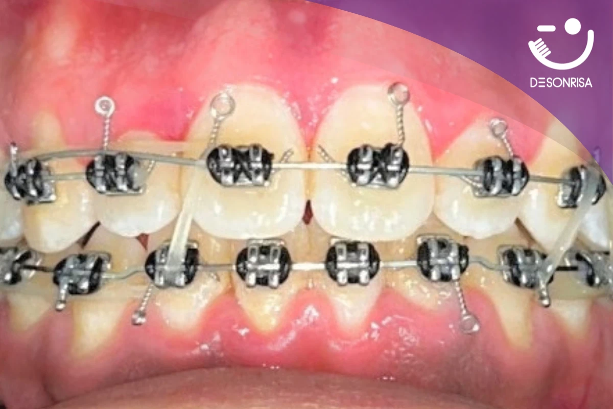 Aplicación de brackets metálicos tradicionales en ortodoncia