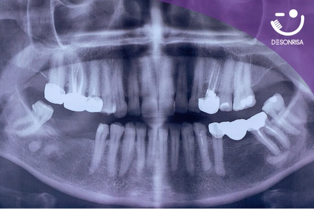Aplicación de Brackets: 1 de cada 3 pacientes de ortodoncia es adulto