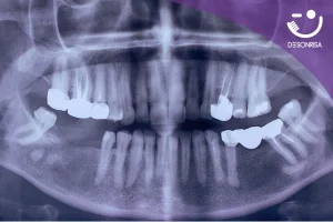 Aplicación de Brackets: 1 de cada 3 pacientes de ortodoncia es adulto