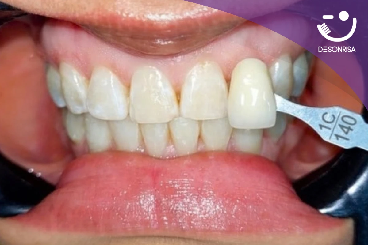 Comparación de tono dental con guía de blanqueamiento dental